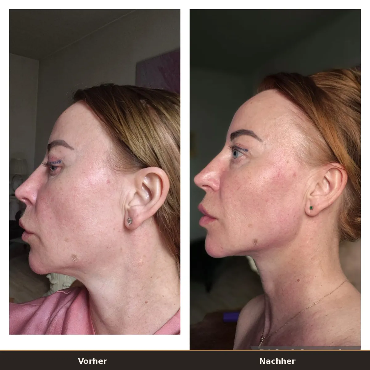 Microneedling Vorher Nachher Profil: links lockerere Kontur, rechts strafferes Hautbild an Kiefer und Hals